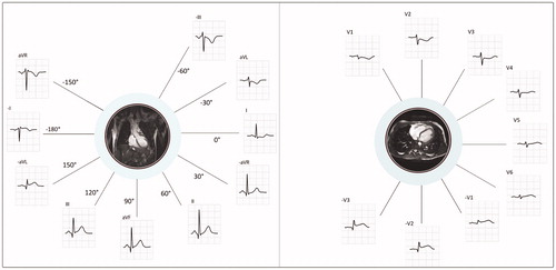 Figure 2. Explanation and basis of the extended STEMI criteria. Limb leads (to the left) and chest leads (to the right) presented in anatomical context.Left image: The inverted version of lead III (–III) is contiguous and presented adjacently to aVL, the inverted version of aVL (–aVL) is contiguous to lead III, and the inverted version of lead I (–I) is contiguous to both –aVL and aVR. The inverse of aVR (–aVR) is contiguous to lead I and lead II. In this purely illustrative example, significant ST elevation is present in only one of the conventional leads (lead III), but in two contiguous leads when the extended STEMI criteria are applied (III and –aVL).Right image: In the extended STEMI criteria, the inversion of leads V1, V2 and V3 (–V1, –V2, –V3) are also included in order to cover the lateral aspects of the left ventricle. ECG shows ST depression in V1 – V3, which is equivalent to ST elevation in –V1, –V2 and –V3.
