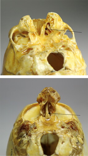 Figure 4. A comparison of cranium 2 (Figure 3) diagnosed holoprosencephaly, mid-line cleft type without facial midaxial structures and cranium 3 eventually diagnosed with Threscher Collin syndrome with midaxial facial structures, but absence of the lateral facial structures. Both specimens have a septum nasi (arrows) which proves that the septum does not develop from the neural crest but from the anterior cartilaginous cranial base. A comparison of the two specimens demonstrates that the orbital cavities are normal in case 2 but abnormal in case 3, lacking the zygomatic bone.