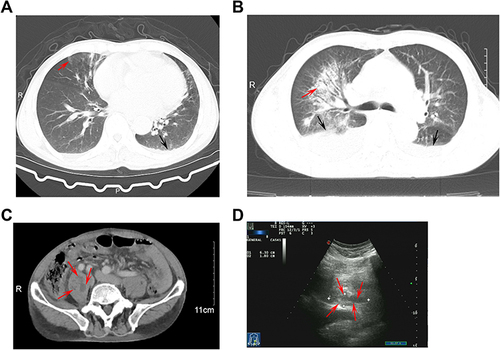 Figure 2 Images of infection caused by Aggregatibacter aphrophilus. (A) CT images of lung at admission; (B) CT images of lung 4 days after admission, the red and black arrows indicate the infection lesions and the pleural effusion on the right lung, respectively; (C) CT images of abdomen 4 days after admission, the red arrows indicate the abscess; (D) Ultrasonic images of the right psoas muscle 5 days after admission, the red arrows shows the abscess region.