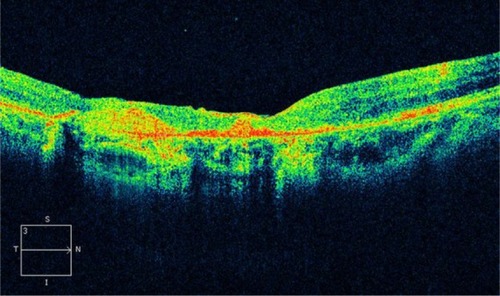 Figure 18 Cirrus™ optical coherence tomography image shows a hyperreflective band, suggesting residual fibrosis of classic choroidal neovascularization.