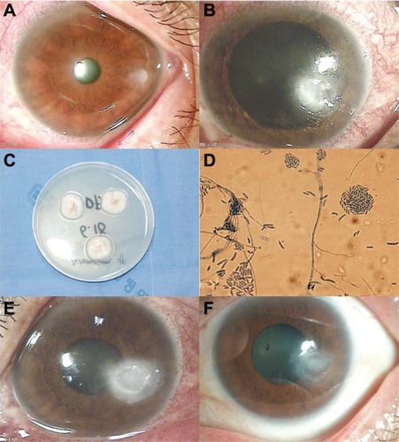 Figure 1 (A) Case 1. At initial examination, a slit-lamp photograph showed a peripheral corneal epithelial defect with a ring-shaped stromal infiltration. (B) Stromal infiltration had increased after 1 week. (C) Colony formation on Sabouraud’s dextrose agar exhibited a white, powdery, suede-like appearance. (D) Lactophenol cotton blue mounting of Acremonium spp. (magnification, 400×). (E) After 4 weeks, the case showed worsening of the infiltrate and a large epithelial defect. (F) After 6 months, biomicroscopy showed complete resolution, with a faint scar.