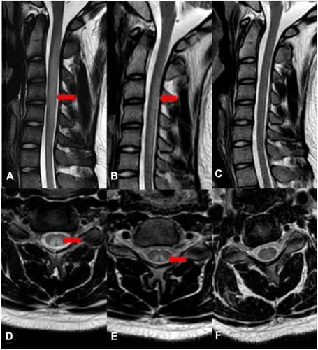 Figure 1 Serial cervical spinal cord MRI in patient with N2O intoxication. (A and D) MRI was performed at the time of first admission. T2-weighted sagittal images showed increased signal intensity and obviously swelling in the cervical spinal cord extending from C2 to C5. T2-weighted axial image showed abnormal signal involving the posterior columns and lateral columns of cervical cord with inverted V sign. (B and E) MRI performed one month later showed the spinal swelling mitigated. T2-weighted axial image still showed inverted V sign. (C and F) MRI performed one year later showed the disappearance of T2WI abnormal signal.
