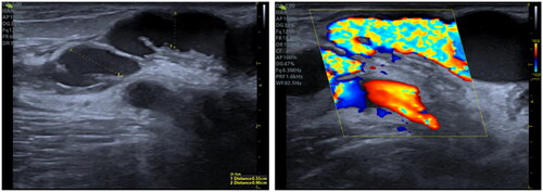 Figure 5. Two weeks after treatment, a paravalvular stenosis in subcutaneous tunnel was detected in a 70-years-old male patient, which eventually progressed to thrombosis 5 months later.
