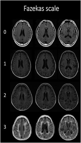 Figure 1. Fazekas scale of periventricular white matter hyperintensities in MRI examples.