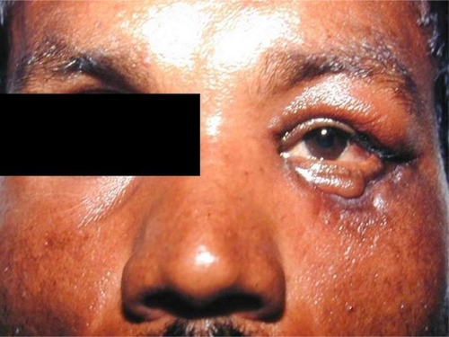 Figure 5 Scarring and ectropion of the left lower lid.