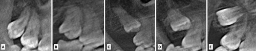 Figure 6 Archer l classification of upper third molars, (A) Type A, (B) Type B, (C) Type C, (D) Type D, (E) Type E.