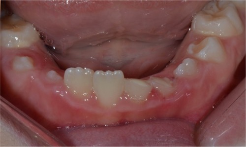 Figure 1 Frontal view of fractured mandibular teeth.