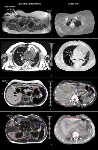 Figure 3. Example OB-MRI/OB-CT image set pairs for four targets: lumpectomy cavity, lung tumor, liver tumor, pancreas tumor (from top to bottom). Contours as drawn by a physician on the OB-MRI (left) and OB-CT (right) image sets are shown for the liver and pancreas cases. Images were selected to display the target, and may not necessarily capture the same exact anatomical slice.
