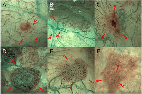 Figure 2. Illustration of the vascular morphology of the bladder mucosa by NBI modality. (A) Fine branching vessels. (B) Thick branching vessels. (C) Reticulated vessels. (D) Disorganized vessels. (E) Dotted vessels. (F) Circumferential vessels. (Red arrow indicates vessel location)