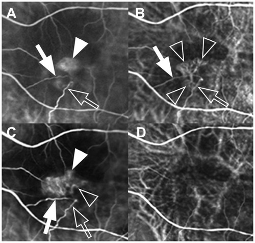 Figure 2 Magnification of early-phase indocyanine green angiography images from Figure 1 at baseline (A), and months 3 (B), 6 (C), and 9 (D). (A–C) This patient with stage 3 retinal angiomatous proliferation had proliferation within the retina (arrowheads) consisting of a preperfusing (arrows) and a draining (outline arrows) retinal vessel communicating with the area of choroidal neovascularization (outline arrowheads). (B and D) Although retinal-choroidal anastomosis (RCA) persisted after three consecutive monthly intravitreal bevacizumab injections, it finally resolved after combined therapy of intravitreal bevacizumab and photodynamic therapy.