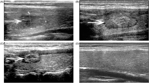 Figure 5. A 50-year-old woman (Patient 3) had a papillary carcinoma in the right lobe of her thyroid gland. The changes in the volume of the nodules before MW ablation and at each follow-up period were presented in the following pictures. (A) Ultrasound examination revealed the solid nodule to be 102 mm3 in volume before MW ablation. (B) Three months after the ablation, the volume of the nodule decreased to 966 mm3. (C) Six months after the ablation, the volume of the nodule decreased to 541 mm3. (D) At another follow-up of this patient approximately 12 months later, we could not find any evidence of tumour and there was no scar at the previous tumour site.