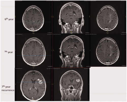 Figure 2. 40 months after completing temozolomide, a heterogeneously contrast-enhanced lesion was found at the left operculum. The patient was right-handed and his left hemisphere was determined to be dominant for speech using functional MRI. A stereotactic biopsy was performed and GBM was confirmed. The patient was enrolled in one of our clinical trials “A Randomized Phase 2 Open Label Study of Nivolumab plus Standard Dose Bevacizumab versus Nivolumab plus Low Dose Bevacizumab”. He since has had disease progression and placed back on temozolomide. The figure shows MRI images with T1 axial contrast enhanced, T1 coronal contrast enhanced and flair axial images from 6th year to recurrence.