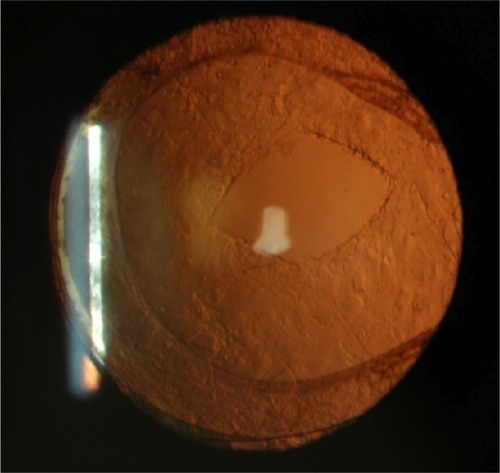 Figure 1 Anterior segment photography immediately after Nd:YAG laser posterior capsulotomy (430×407).