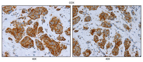 Figure 7 Mitochondrial complex IV (COX) activity is amplified in human epithelial cancer cells, in breast cancer patients (higher-power images). As in Figure 6, except higher power images are shown. Note that human epithelial cancer cell “nests” are intensely stained, as compared with adjacent stromal cells. Original magnification, 40x, as indicated.
