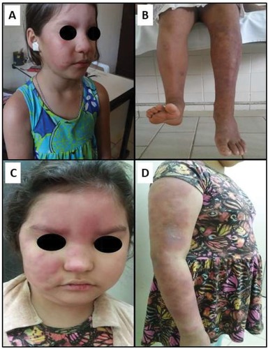 Figure 1 Leprosy reaction in a 9-year-old girl with multibacillary, borderline leprosy. (A) Type I reaction at the time of diagnosis; (B) foot drop (left foot); (C) rounded face with multiple skin lesions (“full moon face”) due to Cushing’s syndrome; and (D) abdomen with fat accumulation due to Cushing’s syndrome.