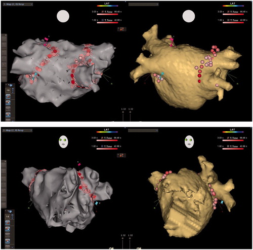 Figure 1. CARTO maps (left) and CT images (right) of the LA in a patient with paroxysmal AF who underwent 1st ablation in the RMN group, PA (upper) and LAO (lower) views, showing detailed reconstruction of the PV antrum as well as PV encircling ablation lines. Note linear ablation was even applied between the well-separated right-sided upper and lower PVs, but only encircling around the common left PV.