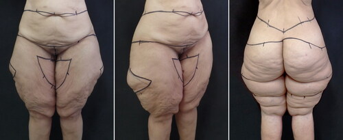 Figure 2. A 39-year-old woman is seen preoperatively. The helical shape of the incision allows skin flaps to maintain perfusion (left and middle pictures); judicious liposuction is performed just on the areas to be excised. The pancake stack deformity is evident on the posterior view: The markings are barely visible due to the severity of skin folds (right picture). The surgery was combined with a lower body lift.