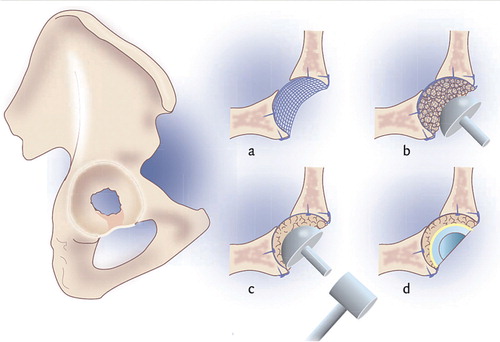 Figure 5. Technique of acetabular impaction bone grafting: (a) after localisation of the defect a mesh is situated and fixated using screws; (b) the contained defect is now filled with bone graft; (c) the grafts are impacted with a hammer and (d) a cemented cup is inserted.