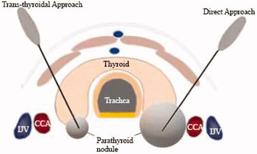 Figure 1. Diagrammatic representation of two different needle-tract routes (trans-thyroidal and direct approach) for percutaneous ablation. CCA: common carotid artery; IJV: internal jugular vein.