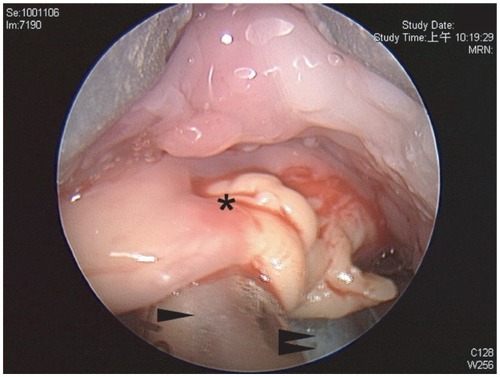 Figure 5 Ruptured cyst*, arrow shows blade, double arrow shows endotracheal tube.