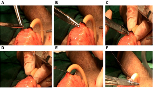 Figure 2 Operation chart: The hole of the neobladder was sutured intermittently with the catheter windings. (A and B) The needle piercing through the wall of the neobladder and coming out of the hole; (C) The needle passing through the catheter windings; (D–F) The suture being tied in a surgical knot.