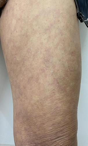 Figure 5 Only brown pigmentation was left on the erythema of the left thigh.