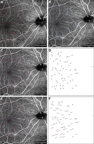 Figure 4 Corresponding positions of bifurcations of the capillaries from pre- and postoperative 6×6 mm OCTA en face images including fovea and disc in Case 6.