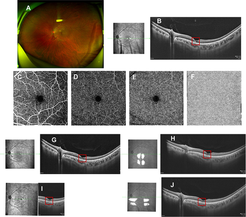Figure 3 Fundus images of the left eye in case 3. Fundus photography (A) was normal. A para-foveal hyper-reflective segment of the OPL and ONL, with associated disruption of ellipsoid, interdigitation zones, and RPE layers on OCT ((B), red box). No flow defects in the superficial (C)/intermediate (D)/deep (E) retinal capillary plexuses and choroidal capillary plexus (F) on OCTA. Three days after oral prednisone administration, hyper-reflectivity of the OPL and ONL mildly faded on OCT ((G), red box). Ten days later, hyper-reflectivity faded with definable ellipsoid, interdigitation zones, and RPE layers on the OCT ((H), red box). A tiny segmental discontinuity of ellipsoid, interdigitation zones, and RPE layers persisted on OCT at the 4-week visit ((I), red box) and 7-week visit ((J), red box).