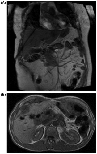 Figure 1. (A) T1-weighted gradient echo (GRE) sequence in the coronal plane to verify sheath position after CT-guided insertion of laser fibres before LITT procedure (FLASH, TE/TR 4.8/119, FA 90°, TA 2 s). Magnetic artefacts are caused by a magnetic marker inside the applicator system to enable a sufficient verification of the position. (B) MRI obtained after removal of the magnetic markers demonstrates the hypointense metastasis from a sarcoma in segment 4b with two laser fibres inserted.