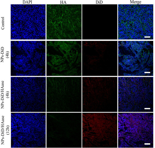 Figure 8 Tumor penetration behavior of NPs-DiD studied by confocal microscopy. The nuclei was stained with DAPI (blue), HA was stained with HABP (green), and NPs-DiD was presented in red. Scale bar represents 100 μm.