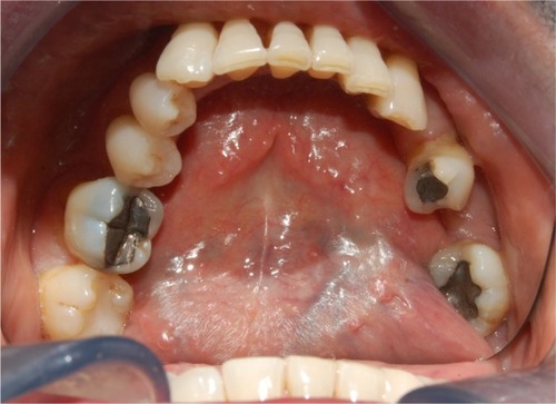 Figure 3 Dry and sticky appearance of oral mucosa in a radiotherapeutic patient.