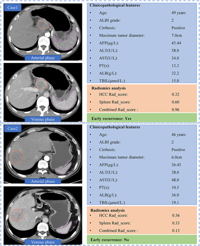 Figure 4 Two presented cases of PA-TACE patients who had distinctly different relapse situations with similar clinicopathological features showed significantly different combined Rad_score (0.96 vs 0.13, p<0.001). In the left CT scan image, the region delineated by the Orange contour represents the area of the liver tumor, while the region delineated by the purple contour represents the area of the spleen. Both contours were manually drawn.