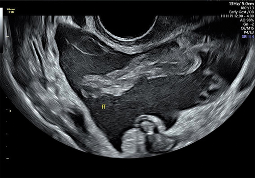 Figure 7. Marked free fluid in the pouch of Douglas.