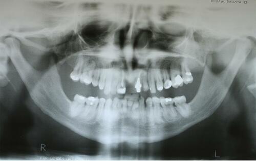 Figure 3 Initial panoramic radiograph.