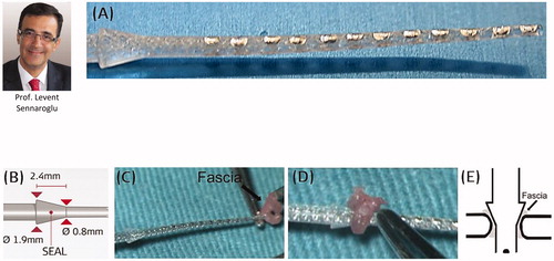 Figure 18. FORM electrode array with cork type insertion stopper (A). CORK stopper dimensions (B) (Image courtesy of MED-EL). Ring of fascia loaded on to the electrode array (C, D). Image showing the CORK type stopper sealing the cochlear opening (E) [Citation21]. Reproduced by permission of Elsevier Ireland Ltd.