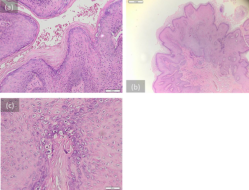 Figure 2 (a–c) Histopathological features of the lesions showed; keratinized stratified squamous epithelium with hyperplastic, acanthosis, hyperkeratosis (a); papillomatosis (b); and koilocytosis (c). No signs of malignancy were found.