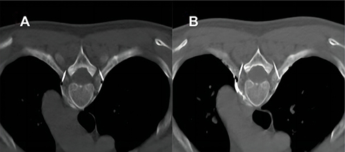 Figure 1 CT-guided chemical thoracic sympathectomy. (A) shows the tip of the puncture needle reaching near the anterior margin of the rib cotyledon; (B) shows the injection of anhydrous alcohol around the thoracic sympathetic chain at the T4 level.