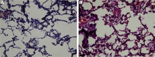 Figure 6 Pathological examination of lung tissues.Notes: (A) Group 1 rabbits showed interstitial inflammatory cell infiltrates and pneumocyte hyperplasia (hematoxylin–eosin staining, 100× magnification). (B) Group 2 rabbits showed a pattern very similar to that observed in Group 1 (hematoxylin–eosin staining, 100× magnification). Group 1 was treated with the penicillin-eluting catheter (20 mg/catheter), and Group 2 received systemic intramuscular administration of penicillin (10 mg/kg every 2 days with a non-drug eluting catheter).