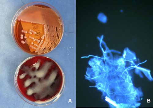 Figure 3 (A) Klebsiellasubsp. from secretions under the scab of the lesion on a MacConkey agar plate (top) and on a blood plate (bottom). (B) Positive oral mucosa fungus microscopic examination.