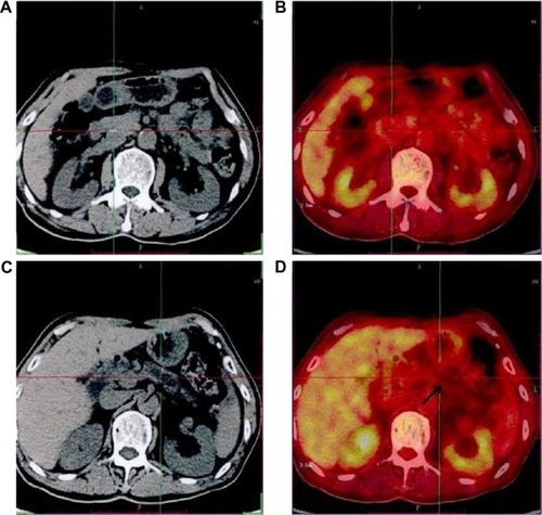 Figure 1 Images of a male participant, 69 years.Notes: Computed tomography showed that there was a suspicious lesion in his pancreas. His carbohydrate antigen 19-9 level was 51.68. 18F-FDG PET/CT showed that there was no lesion with increased 18F-FDG uptake in his pancreas. Finally, he was diagnosed with chronic mass-forming pancreatitis. (A) Pancreatic head lesion in computed tomography; (B) pancreatic head lesion in 18F-FDG PET/CT; (C) pancreatic duct dilatation in computed tomography; and (D) pancreatic duct dilatation in 18F-FDG PET/CT.Abbreviations: PET, positron emission tomography; CT, computed tomography.