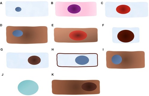 Figure 1 The cellular model of each marker positive staining.Note: (A) Negative staining; (B) H&E staining; (C) Ki-67 nuclear positive staining; (D) p16 cytoplasmic positive staining; (E) p16 cytoplasmic and Ki-67 nuclear co-positive staining; (F) ProEx™ C nuclear positive staining; (G) HPV L1 capsid protein nuclear positive staining; (H) Claudin 1 membranous positive staining; (I) IMP3 cytoplasmic positive staining; (J) Feulgen-thionin staining for DNA; and (K) RKIP nuclear and cytoplasmic positive staining.Abbreviations: HPV, human papillomavirus; IMP3, insulin-like growth factor-II mRNA-binding protein 3; RKIP, Raf kinase inhibitor protein.