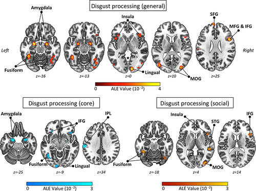 Figure 3 Brain clusters of spatially convergent patterns of activation in the general disgust processing dataset (main ALE analysis of Gan et al (2022);Citation61 top panel), core disgust processing dataset (subanalysis 1 of Gan et al (2022); bottom left panel), and social disgust processing dataset (subanalysis 2 of Gan et al (2022); bottom right panel). Results were FWE-corrected at 0.05 with cluster-forming value at p <.001 by Gan et al (2022) via GingerALE (v. 3.0.2.; http://www.brainmap.org/ale/). The activation likelihood activation (ALE) maps are visualized as axial slices (2-D cortical and subcortical view). Brain templates are in neurological convention (ie, R is right, L is left).