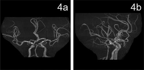 Figure 4. Head MRA results 3 months after surgery.(a, b) MRA showed the basilar artery lumen was patent.