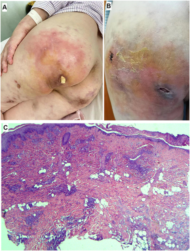 Figure 2 (A) A new rash on the left Hip after abscess drainage; (B) the rash was aggravated after antibiotic treatment; (C) H&E staining of a left Hip erythema showed features of purulent inflammation that involved with dermis and subcutaneous fatty tissue (25×).