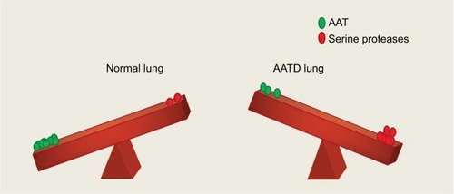 Figure 3 Protease/antiprotease balance shown in the lung of a healthy individual and a person with AATD. In a normal individual, the lung parenchyma is protected from serine protease activity of NE, CathG and PR3 by AAT. In an AATD individual, unchecked levels of proteases damage lung tissue due to low levels of AAT.Abbreviations: AAT, alpha-1 antitrypsin; AATD, AAT deficiency; CathG, cathepsin G; NE, neutrophil elastase; PR3, proteinase 3.