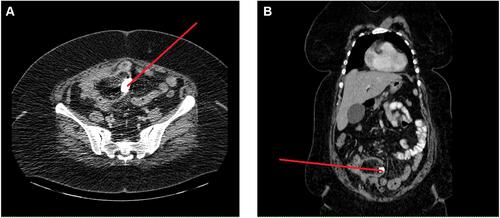 Figure 1 CT scan (A) axial view and (B) coronal view indicating dilation of the distal bowel loops that contained impacted fecal material and multiple linear dense radiopaque material (red arrow) associated with fat stranding with suspected foreign body.