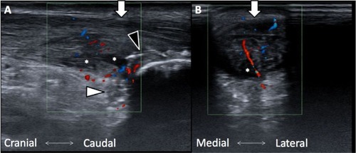 Figure 2 (A) Achilles tendon swelling, partial tear, and retrocalcaneal bursitis. Increased blood flow as revealed under color Doppler view. (B) Achilles tendon swelling and partial tear in a transverse view. Asterisks, tear site; black arrowhead, calcified lesions; white arrowhead, retrocalcaneal bursa; white arrow, Achilles tendon. Increased blood flow is shown with red and blue dots as revealed under color Doppler view.