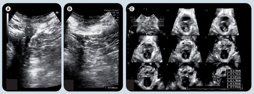 Figure 10. 2D parasagittal oblique views of the puborectalis muscle obtained by translabial ultrasound.(A) An avulsion on the patient’s right (marked by *). (B) Intact muscle on the patient’s left. (C) Tomographic representation of the puborectalis muscle in the same patient, with the avulsion evident in most slices (marked by *).Reproduced with permission from Citation[39].