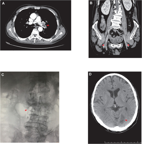 Figure 2 Computed tomography scan revealed a thrombus floating in the left pulmonary artery and branches (A) with a bilateral femoral vein thrombosis (B). Digital subtraction angiography (DSA) showed inferior vena caval filters were implanted in the inferior vena at L2 level with luminal patency (C). Emergency computed tomography (CT) scan showed cerebral infarction (D).