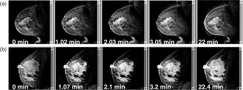 Figure 3. Sequence of DCE-MRI images taken before (time t = 0 min) and after bolus injection of the contrast agent Gd-DTPA for two different patients: (a) centrifugal enhancement, (b) centripetal enhancement.